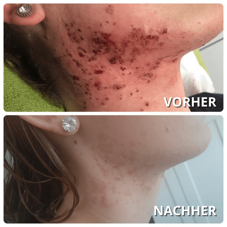 Vorher/Nachher Bilder Aknenarben