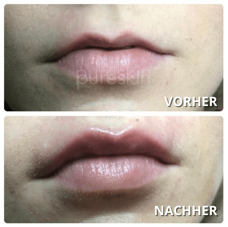 hyaluronpen Ergebnis