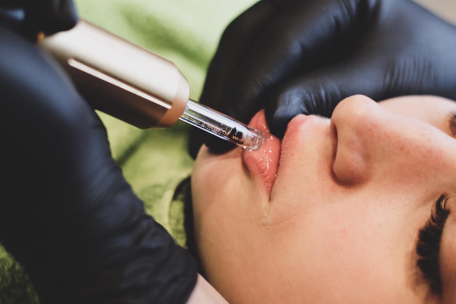 Die Lippen einer Frau unter einer Hyluronbehandlung